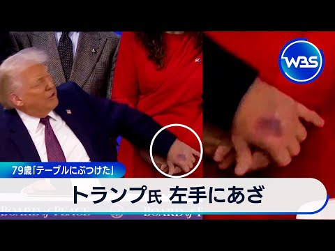 トランプ氏 左手にあざ　79歳「テーブルにぶつけた」【WBS】 サムネイル