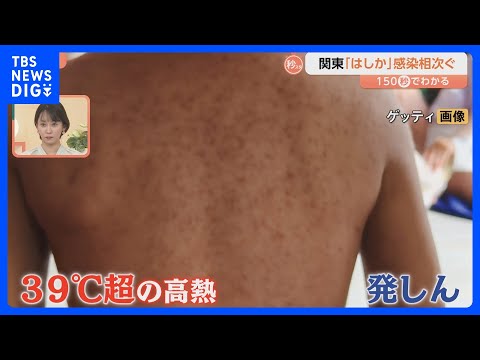 極めて感染力が強い「はしか」関東で報告相次ぐ　感染すると免疫がリセットされることも【Nスタ解説】　｜TBS NEWS… サムネイル